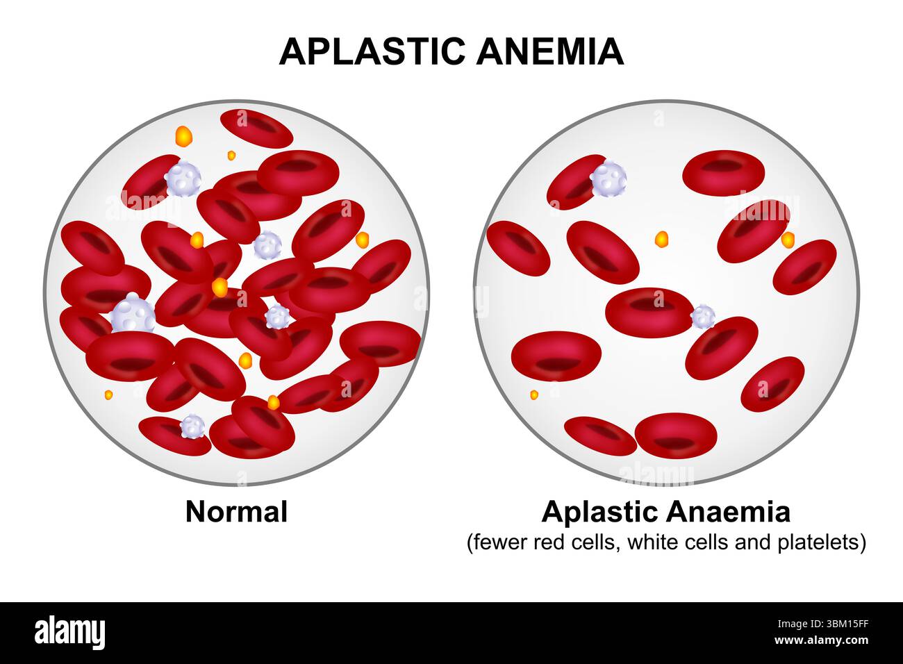 Anemia aplastica Foto Stock
