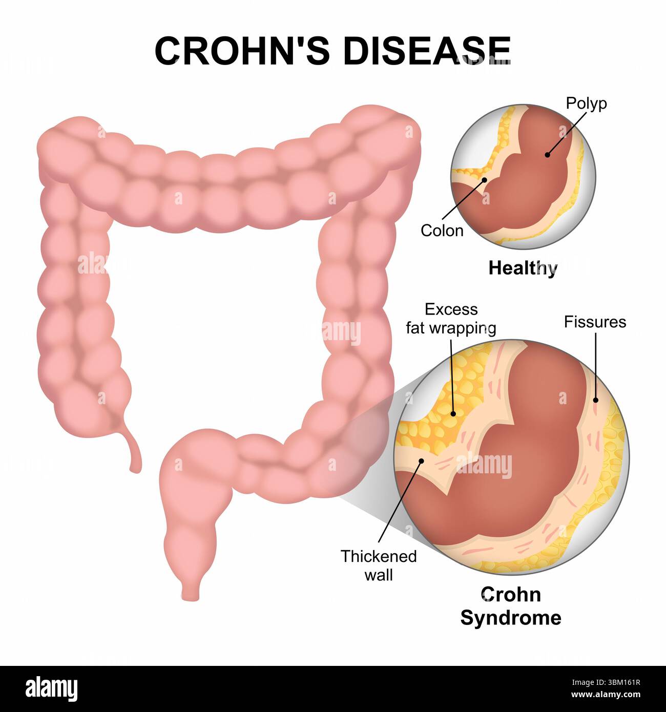 Morbo di Crohn Foto Stock