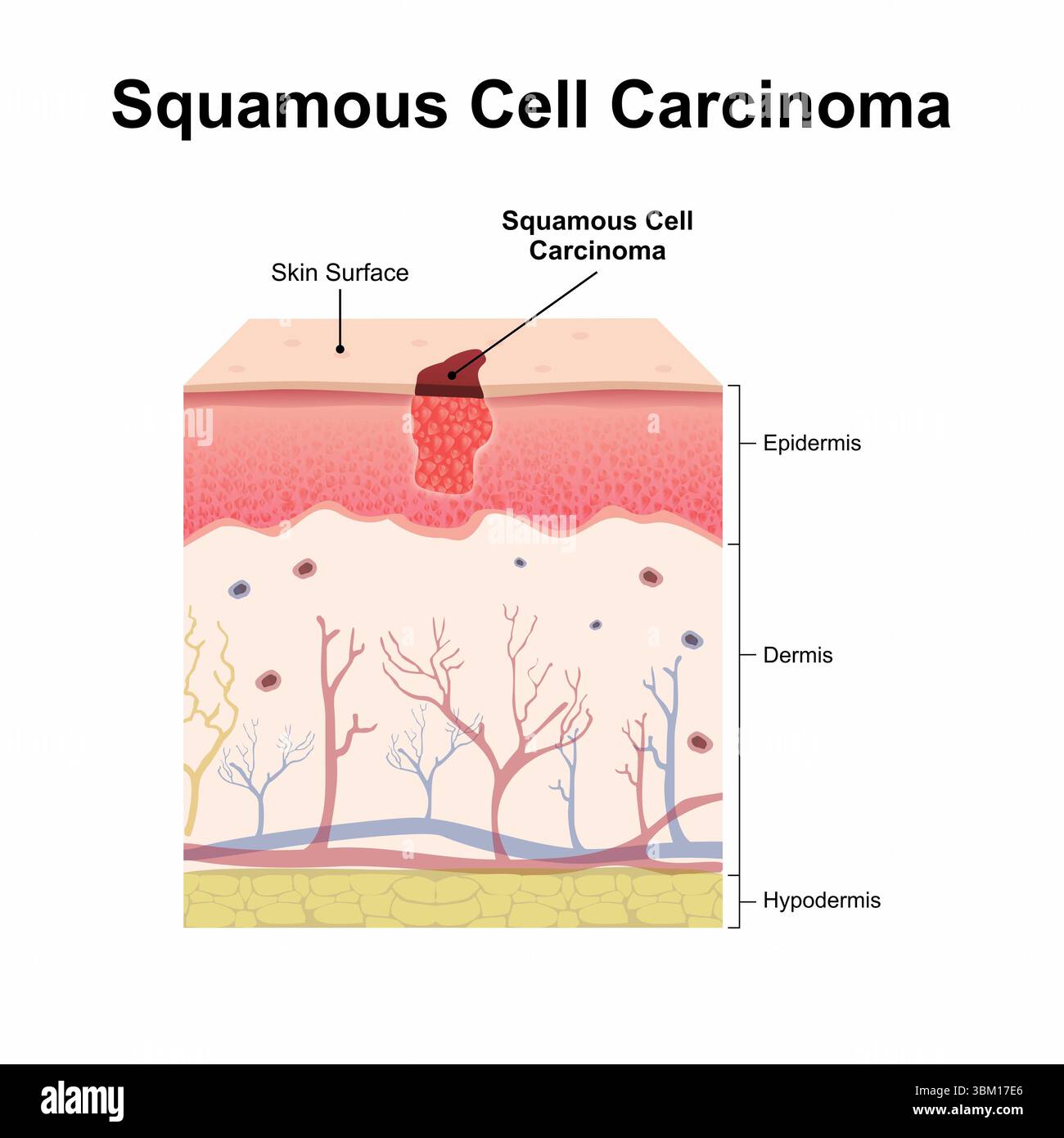 Illustrazione della cute del carcinoma a cellule squamose Foto Stock
