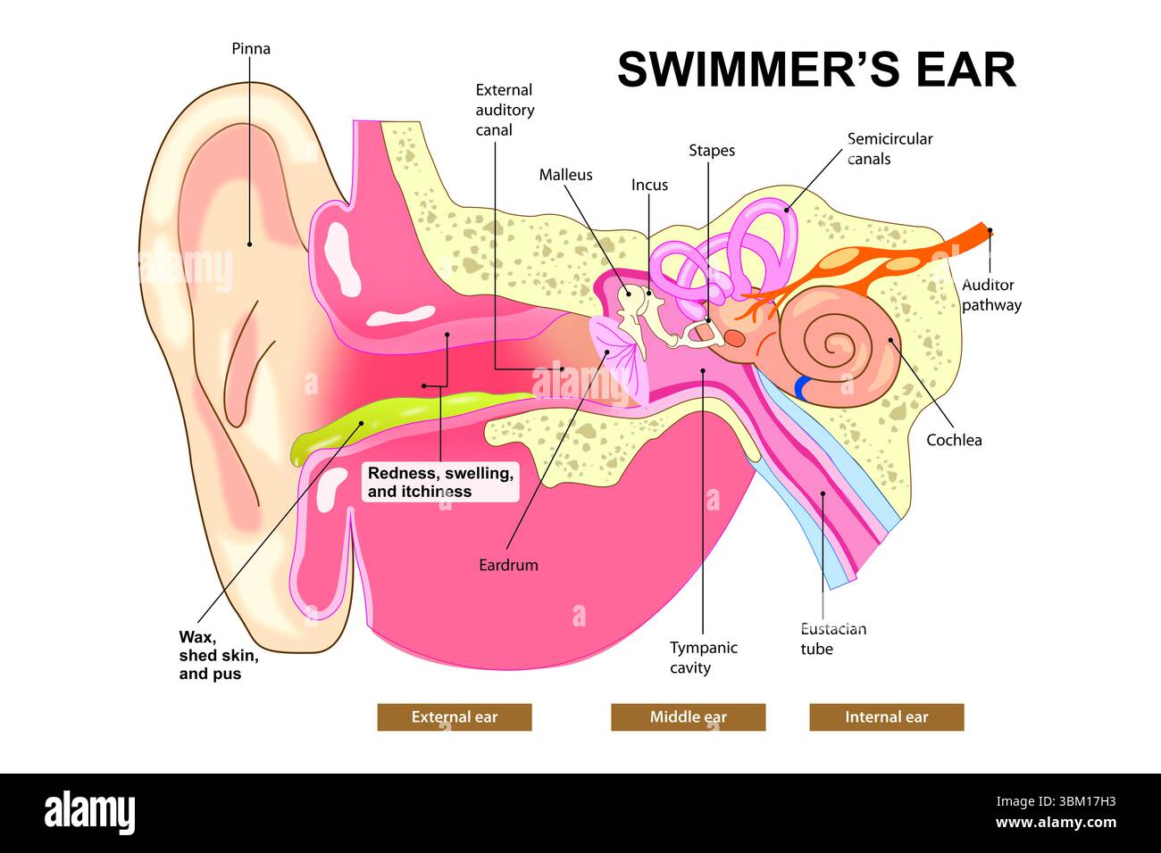 Illustrazione dell'orecchio del nuotatore Foto Stock