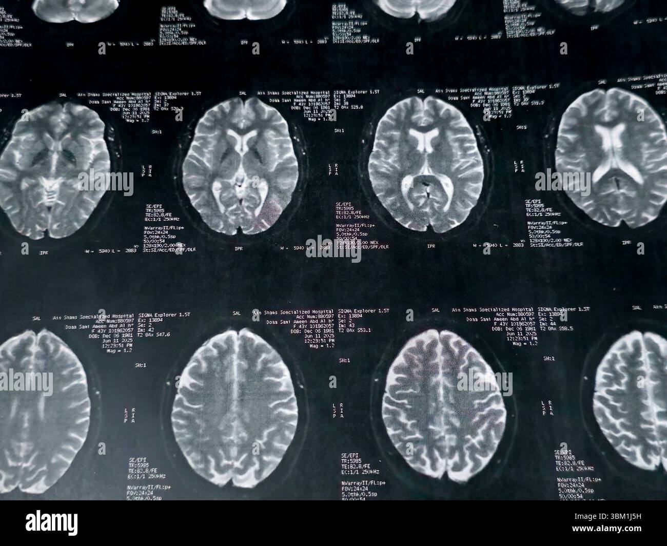 Cairo, Egitto, 17 giugno 2025: MRI MRA Brain mostra pochi frammenti di materia bianca bilaterale, pochi foci discreti di segnale alterato visti apprezzare si luminoso Foto Stock