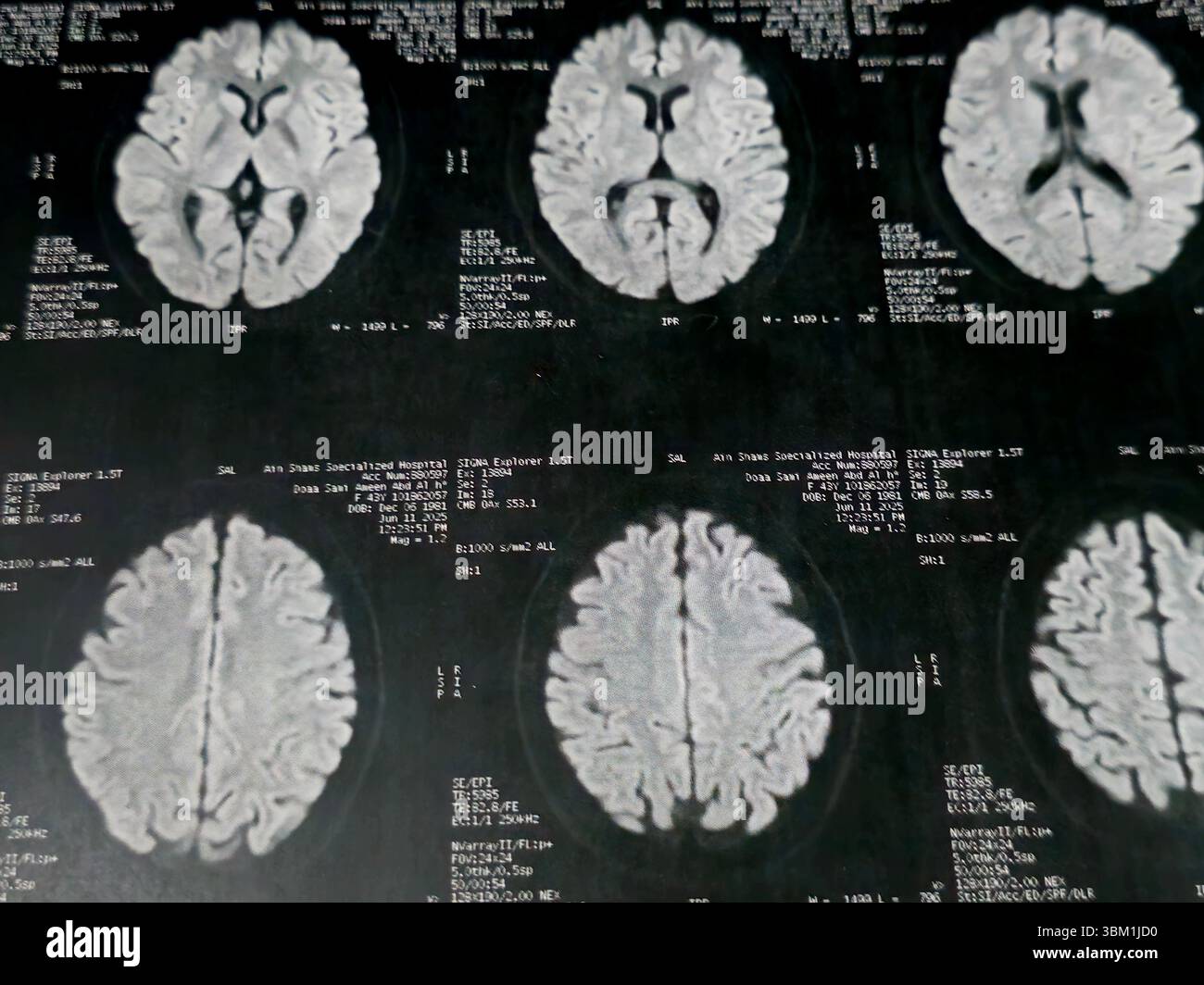 Cairo, Egitto, 17 giugno 2025: MRI MRA Brain mostra pochi frammenti di materia bianca bilaterale, pochi foci discreti di segnale alterato visti apprezzare si luminoso Foto Stock