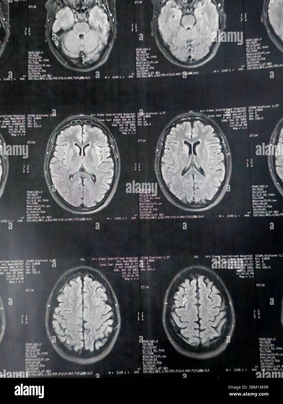 Cairo, Egitto, 17 giugno 2025: MRI MRA Brain mostra pochi frammenti di materia bianca bilaterale, pochi foci discreti di segnale alterato visti apprezzare si luminoso Foto Stock