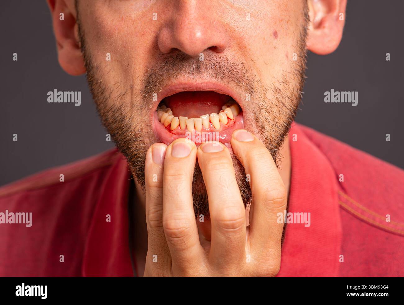 Uomo che mostra gengive infiammate e sanguinanti come sintomo di parodontite, scarsa igiene orale e cure dentistiche Foto Stock