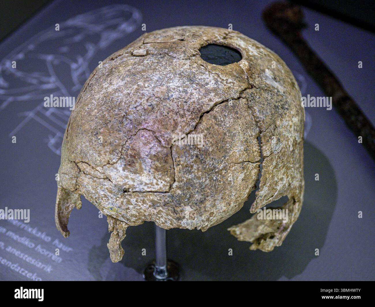 Trepanierter Schaedel, 10 anni. Jahrhundert, Nekropole von Mendraka, Elorrio, Arkeologi Museoa, museo aqueologico, Bilbao, Bizkaia, Pais Vasco, spagnolo Foto Stock