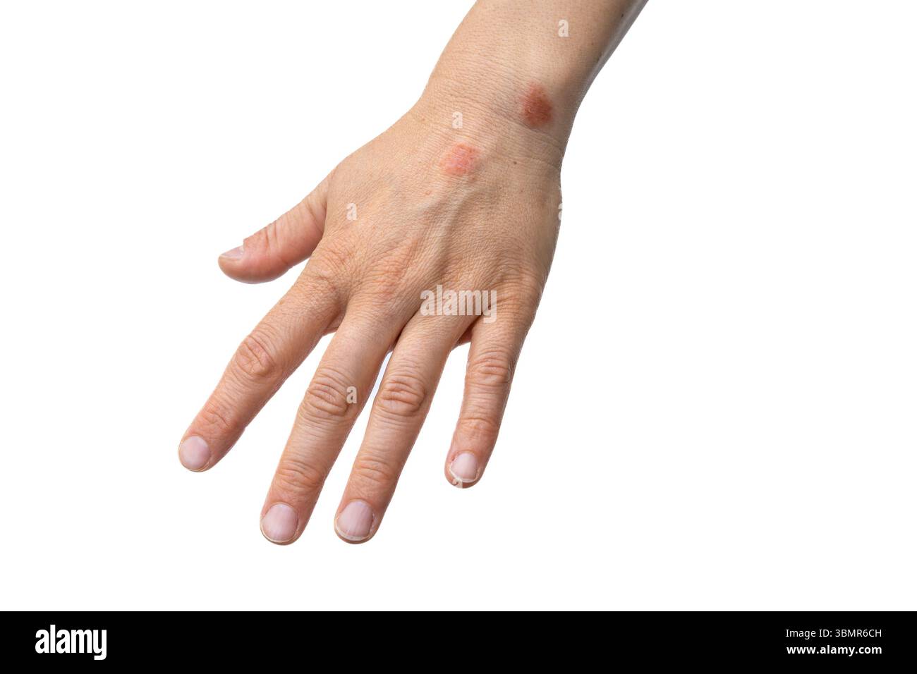 Eczema colpito mano umana isolato su sfondo bianco, Un caso di dermatite caratterizzato da prurito, arrossamento e un'eruzione cutanea Foto Stock