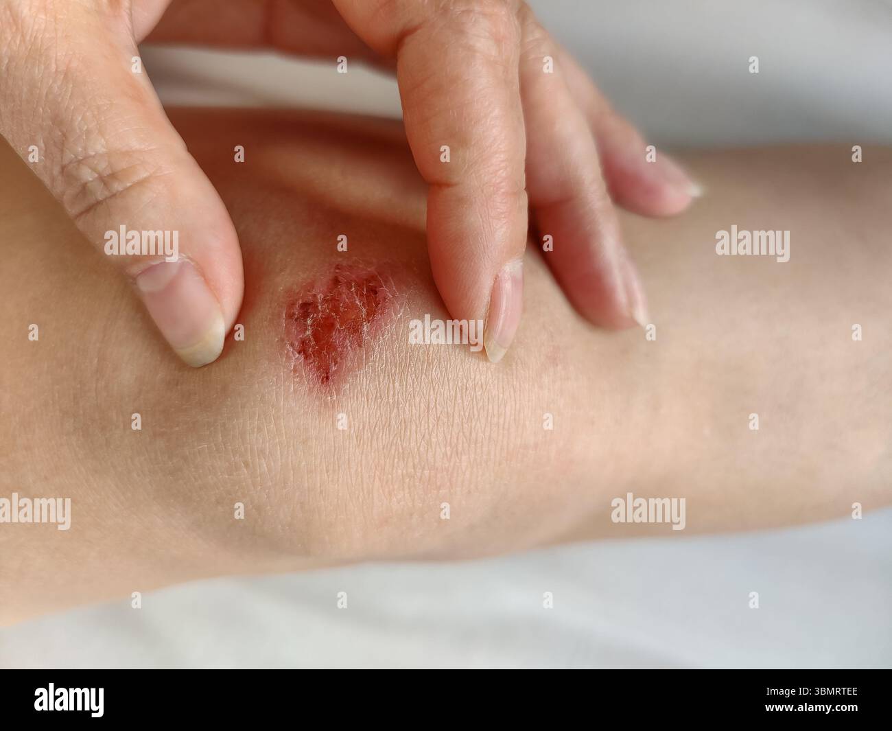 Ferita al ginocchio di una giovane donna snella. Guarigione della lesione cutanea dopo la caduta. Esame della superficie cutanea contro un foglio bianco. Vista dall'alto. Primo piano. Servizio fotocopie Foto Stock