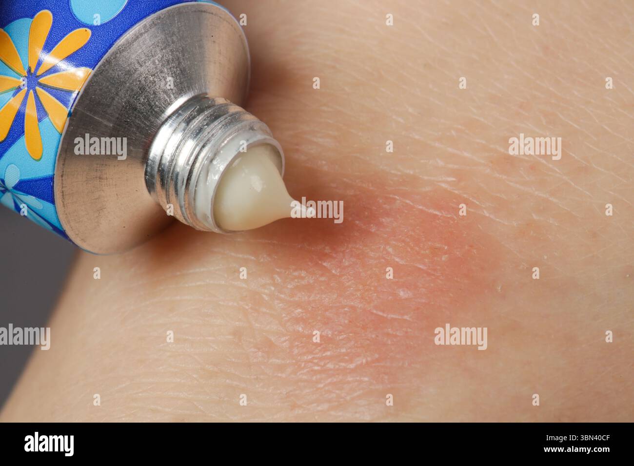 Immagine ravvicinata dell'unguento applicato sull'eczema. Dermatite atopica. Concetto di cura della pelle e di assistenza sanitaria Foto Stock