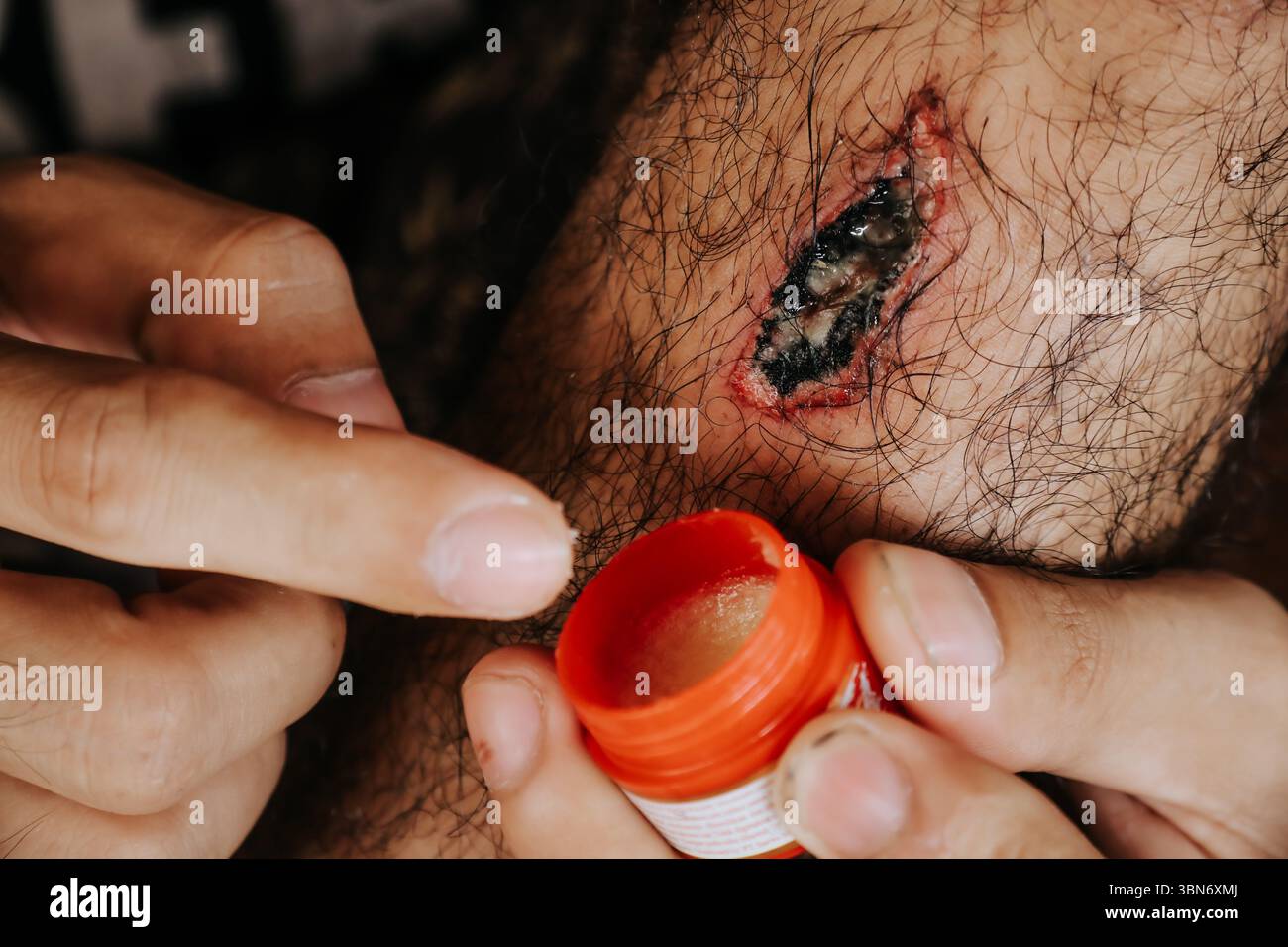 Primo piano della ferita sulla gamba pelosa trattata con unguento. Una persona che applica la crema su una lesione cutanea, il trattamento è necessario per evitare infettività Foto Stock