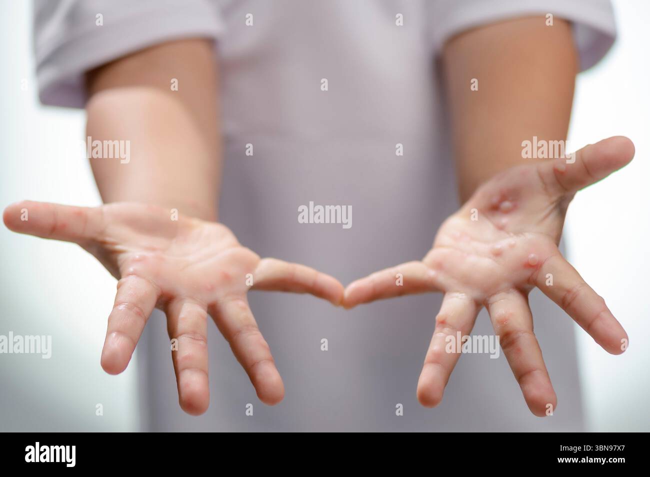 Mano, afta epizootica HFMD mano umana di scarlattina nel virus palmarosa del coxsackievirus e mano del bambino su sfondo bianco Foto Stock