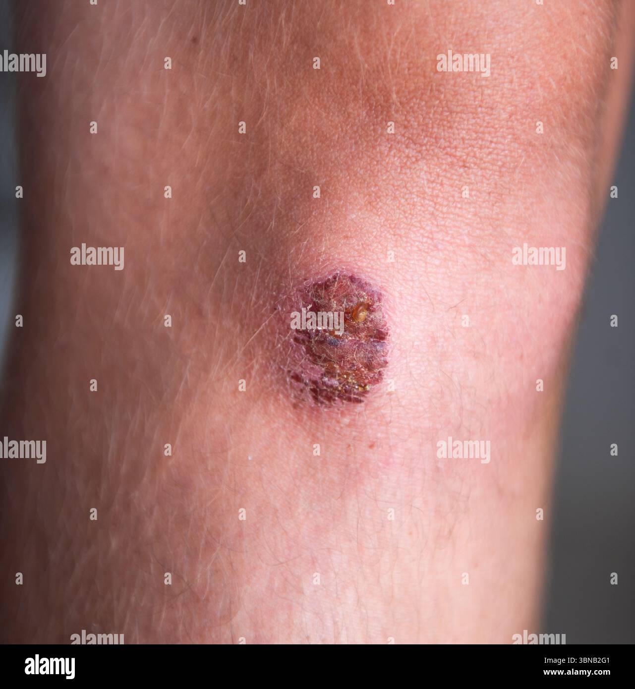 Primo piano dettagliato di una lesione cutanea su un braccio, enfatizzando la consistenza e il colore, illustrando il significato della salute della pelle e la necessità di un medico Foto Stock