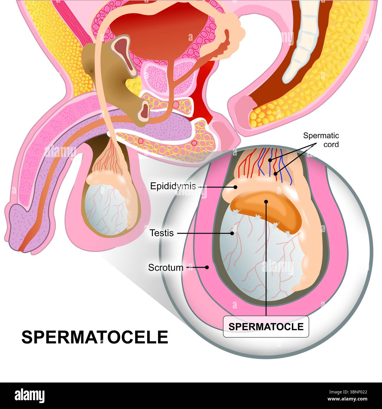 Spermatocele in illustrazione testicolare maschile Foto Stock