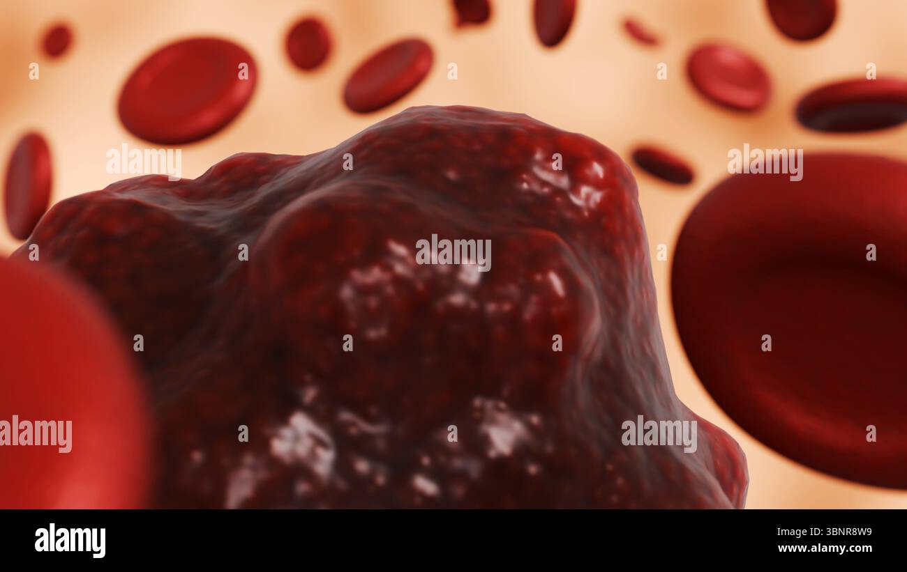 Rendering 3d di un campione di sangue contenente una formazione cancerosa, che fornisce una rappresentazione di un tumore del sangue o di una cellula maligna. Foto Stock