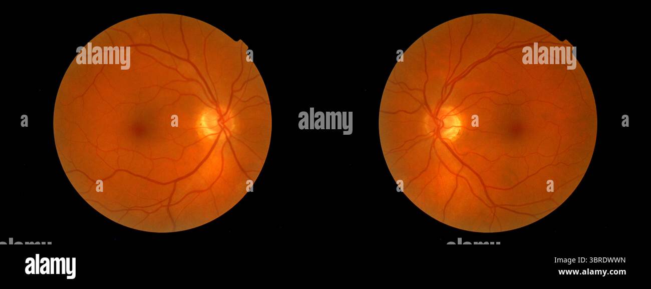 Diagnosi medica immagine di una retina con vasi sanguigni all'interno dell'occhio umano. Tilburg, Paesi Bassi. Autismo. MR=SÌ Foto Stock