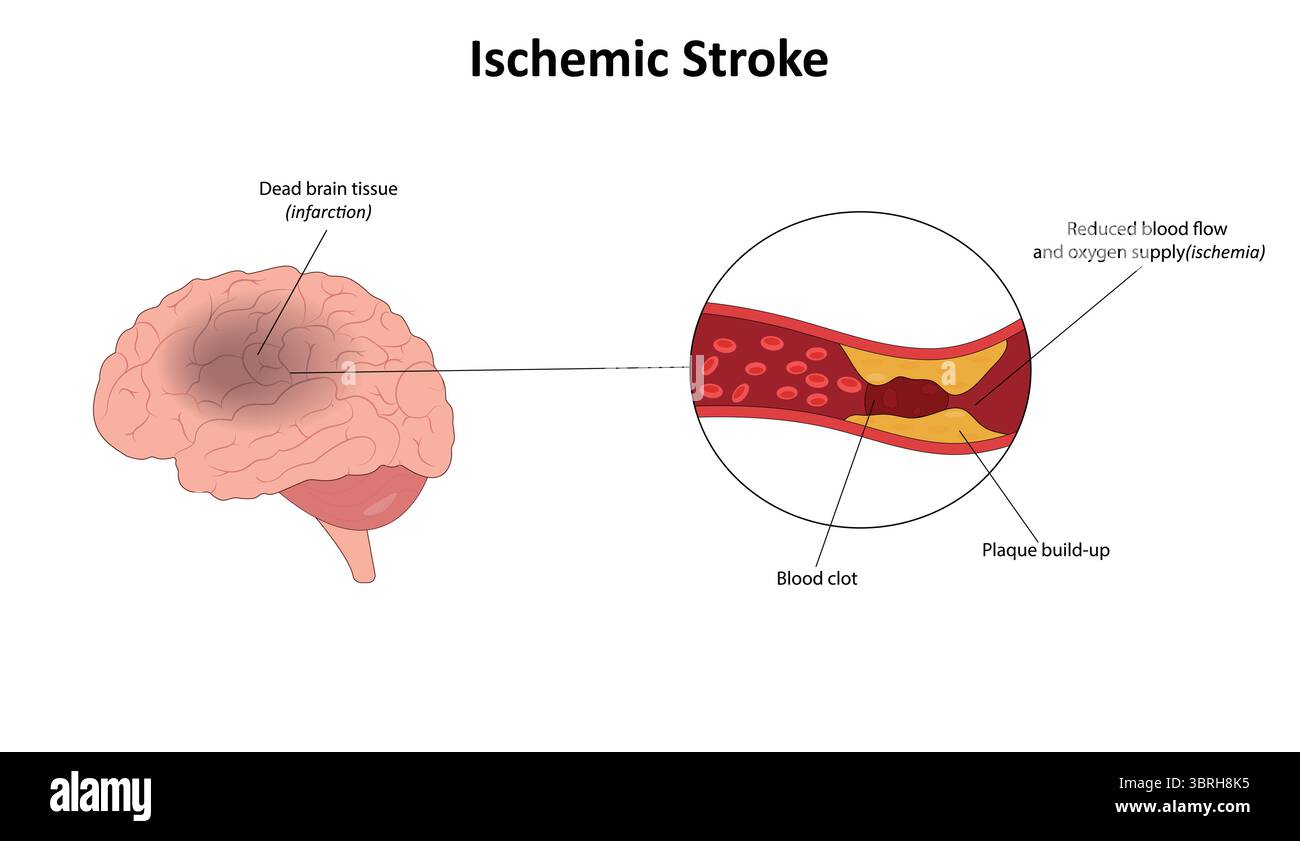 Illustrazione del vettore ictus ischemico Illustrazione Vettoriale