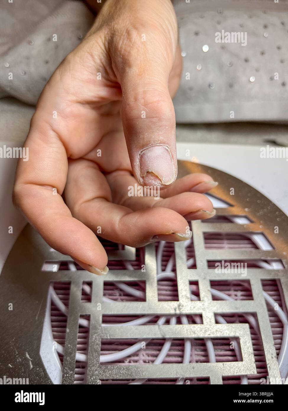 Vista ravvicinata di una mano che mostra onicolisi, con separazione e scolorimento delle unghie, che illustra traumi e infezioni fungine, concentrandosi sul nai Foto Stock