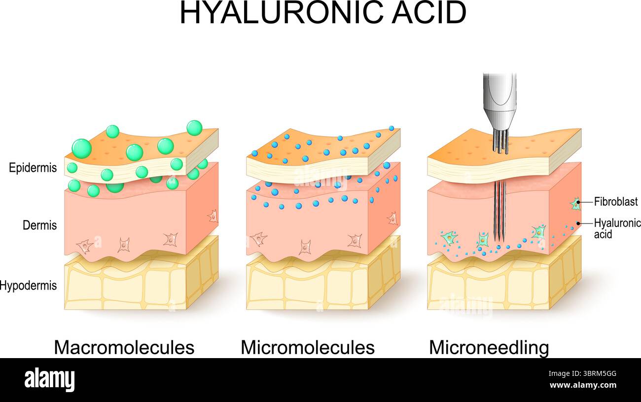 Erogazione di acido ialuronico nella pelle, microneedling, micromolecole, macromolecole. Poster dettagliato del vettore Illustrazione Vettoriale