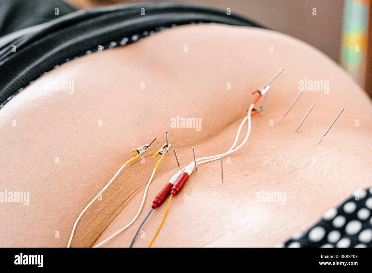 La terapia con elettroagopuntura con aghi e fili stimola i nervi della schiena. Sollievo dal dolore. Trattamento della colonna vertebrale. Riabilitazione fisica. tec. Ortopedica manuale Foto Stock