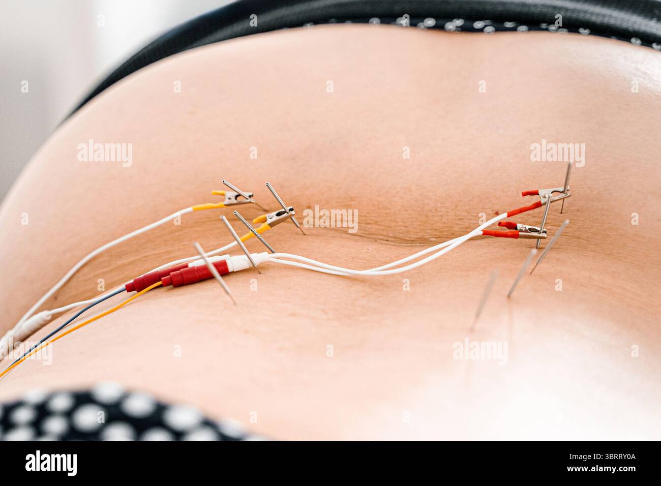 La terapia con elettroagopuntura con aghi e fili stimola i nervi della schiena. Sollievo dal dolore. Trattamento della colonna vertebrale. Riabilitazione fisica. tec. Ortopedica manuale Foto Stock