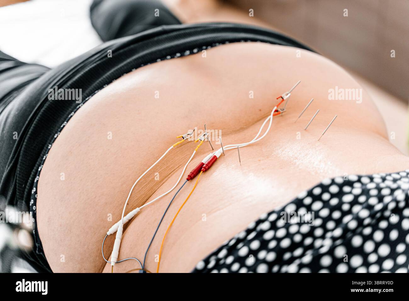 La terapia con elettroagopuntura con aghi e fili stimola i nervi della schiena. Sollievo dal dolore. Trattamento della colonna vertebrale. Riabilitazione fisica. tec. Ortopedica manuale Foto Stock