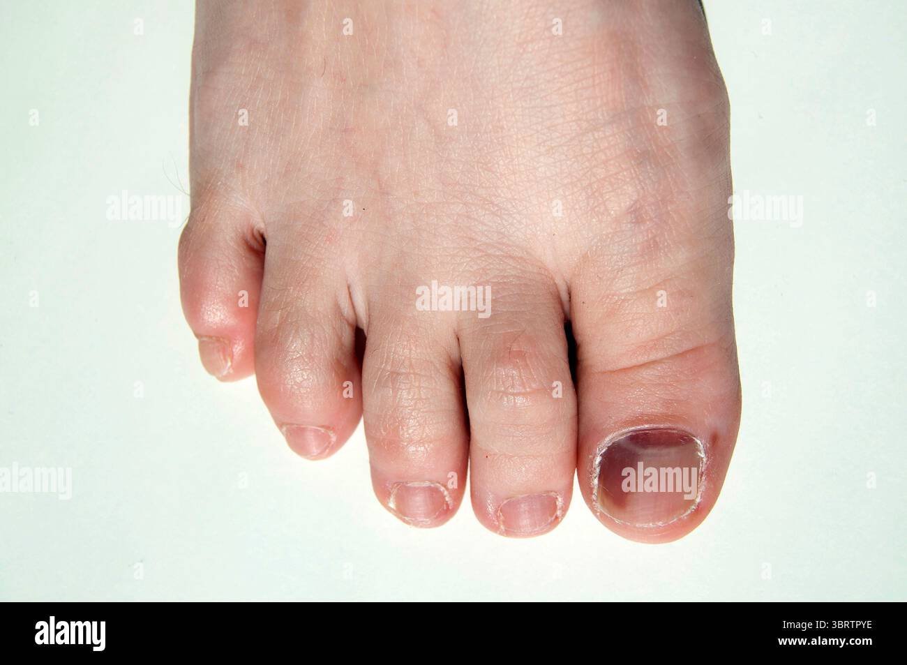 Un primo piano di un piede femminile con un'unghia del piede malata. Foto Stock
