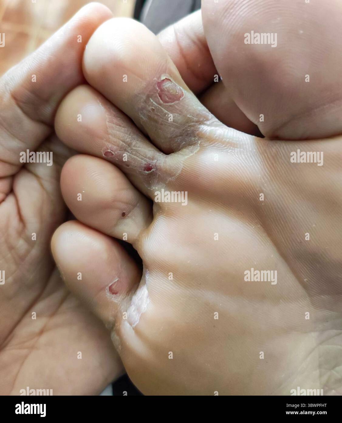 Primo piano di un piede atleta con pelle asciutta e screpolata e irritazione rossa tra le dita dei piedi. Foto Stock
