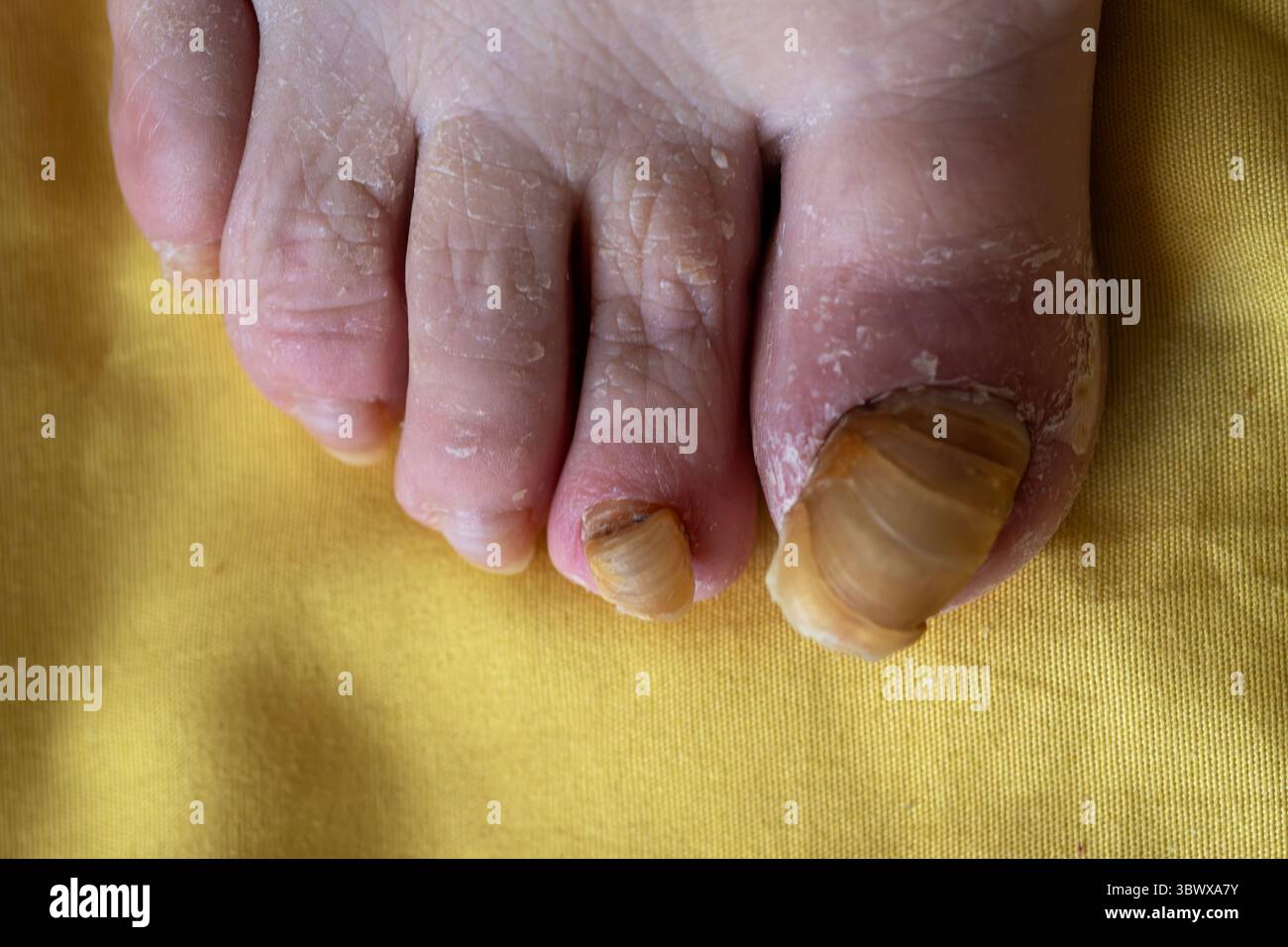 Infezione fungina delle unghie del dito: Primo piano del piede di una donna anziana su foglio giallo Foto Stock