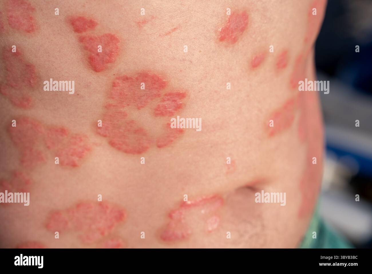 La vista ravvicinata rivela le caratteristiche della psoriasi sulla pelle di una persona schiena, mostrando macchie rosse e incrostazioni tipiche di questa condizione della pelle. Foto Stock