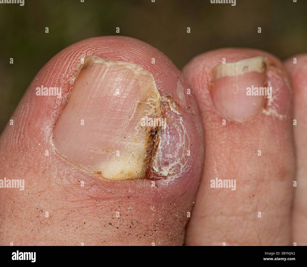 unghia del piede danneggiata che mostra infezione fungina, scolorimento, e pelatura, ideale per medico, podologia, o didattica e conten di scorte legate alla dermatologia Foto Stock