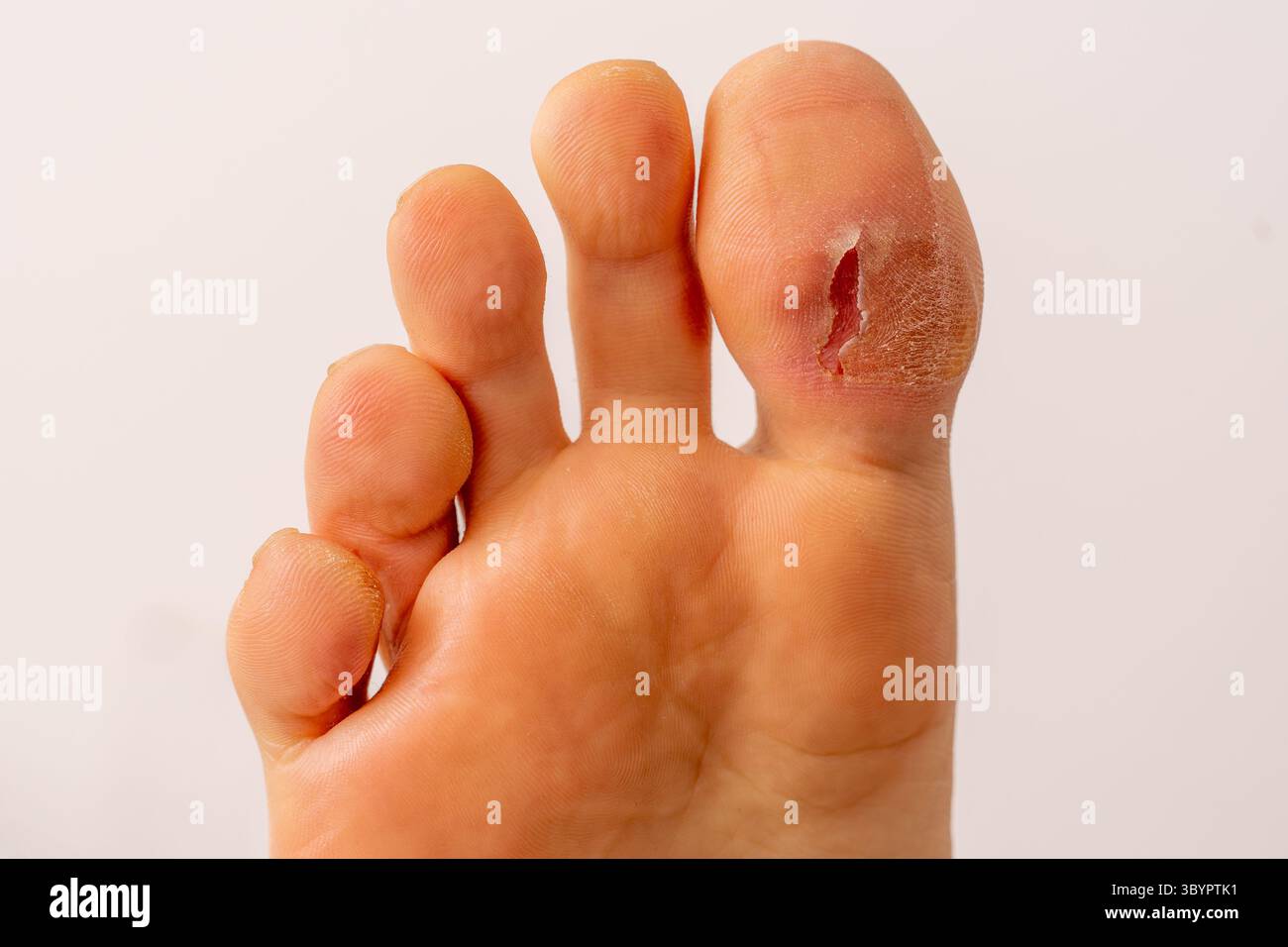 Blister aperto sull'alluce grazie ai piedini piatti nel maschio adulto isolato sul bianco Foto Stock
