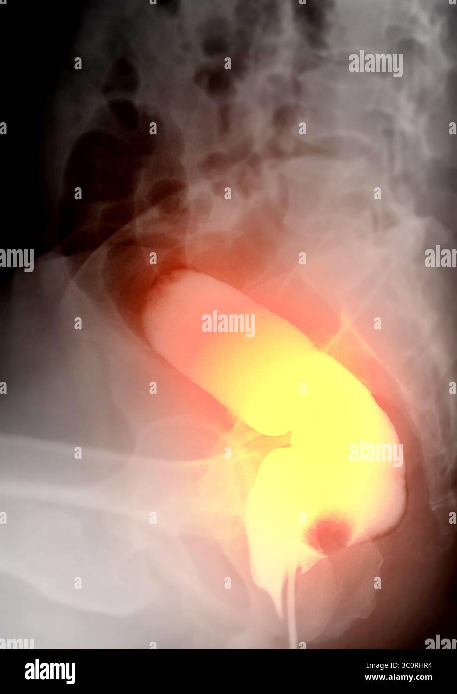Immagine diagnostica dell'enema del bario che mostra la presenza di diverticolosi nel colon trasversale e ascendente, dimostrando la tipica f diverticolare Foto Stock