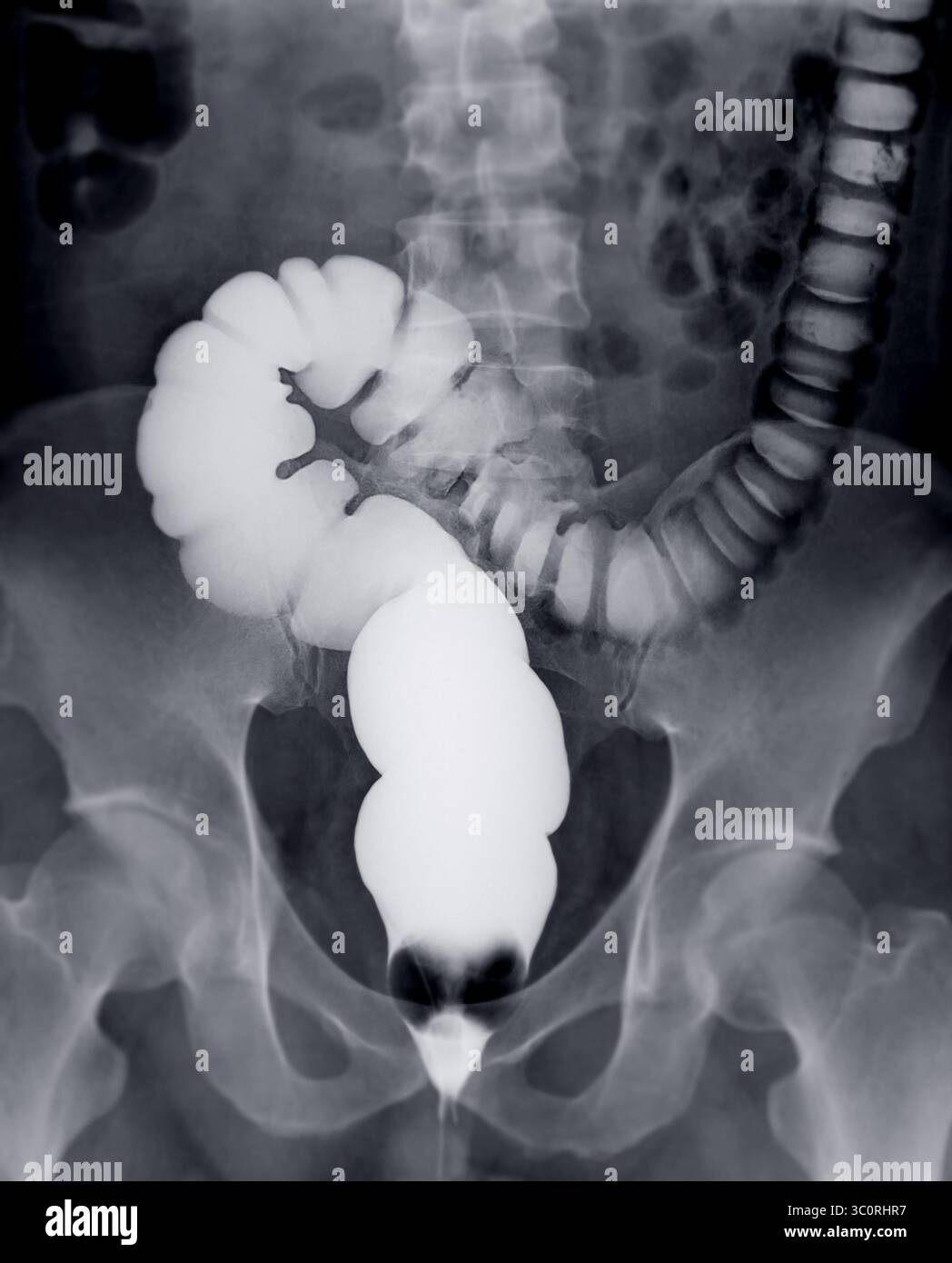Immagine diagnostica dell'enema del bario che mostra la presenza di diverticolosi nel colon trasversale e ascendente, dimostrando la tipica f diverticolare Foto Stock