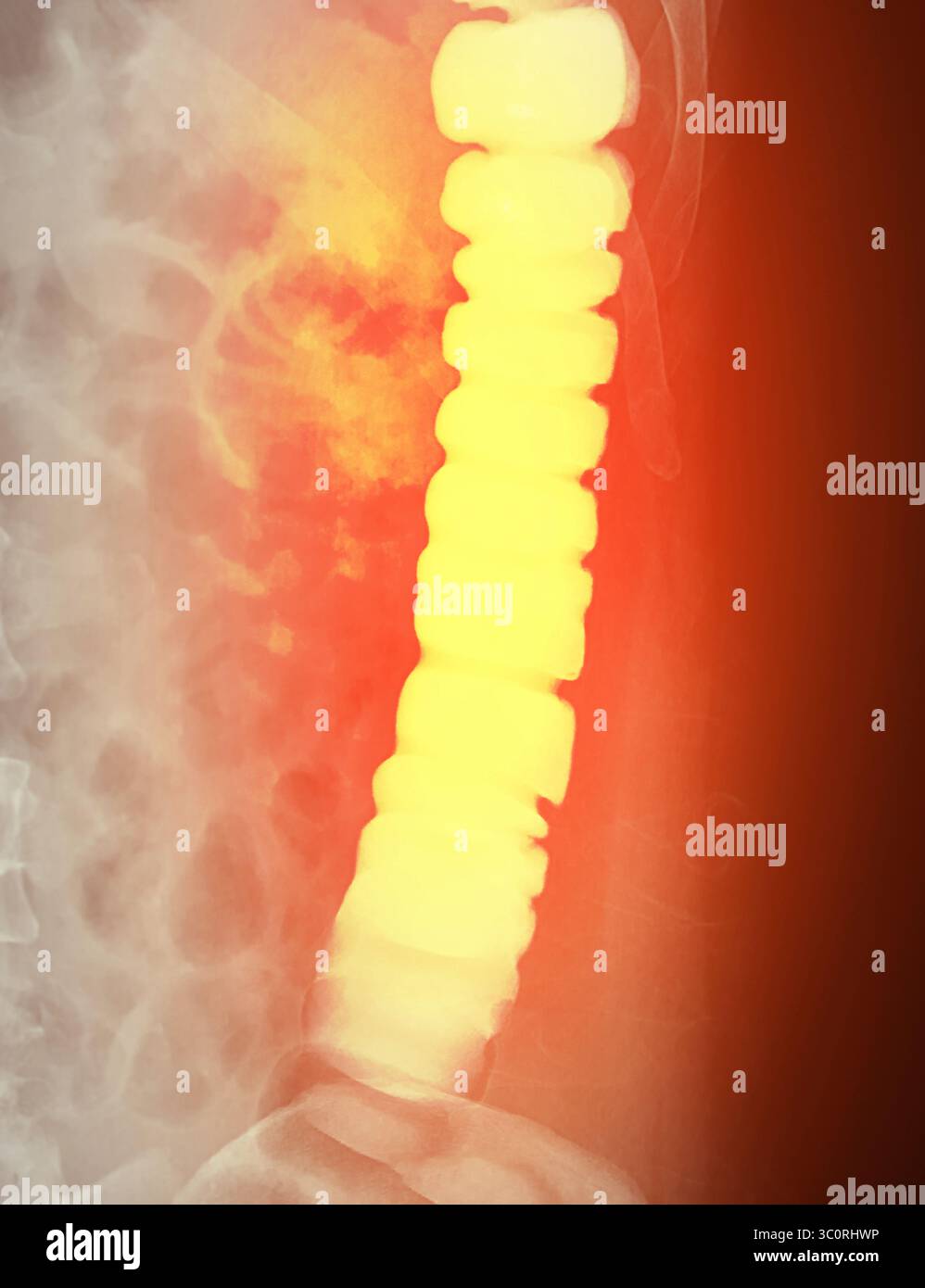 Immagine diagnostica dell'enema del bario che mostra la presenza di diverticolosi nel colon trasversale e ascendente, dimostrando la tipica f diverticolare Foto Stock