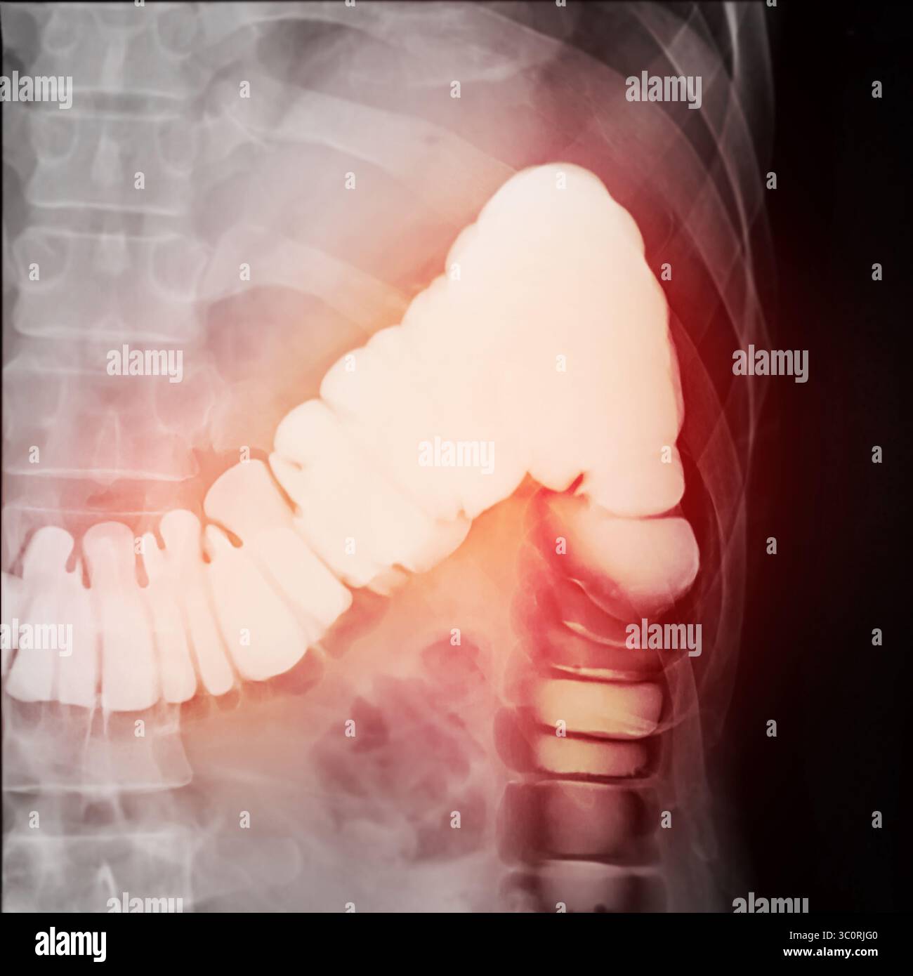 Immagine diagnostica dell'enema del bario che mostra la presenza di diverticolosi nel colon trasversale e ascendente, dimostrando la tipica f diverticolare Foto Stock