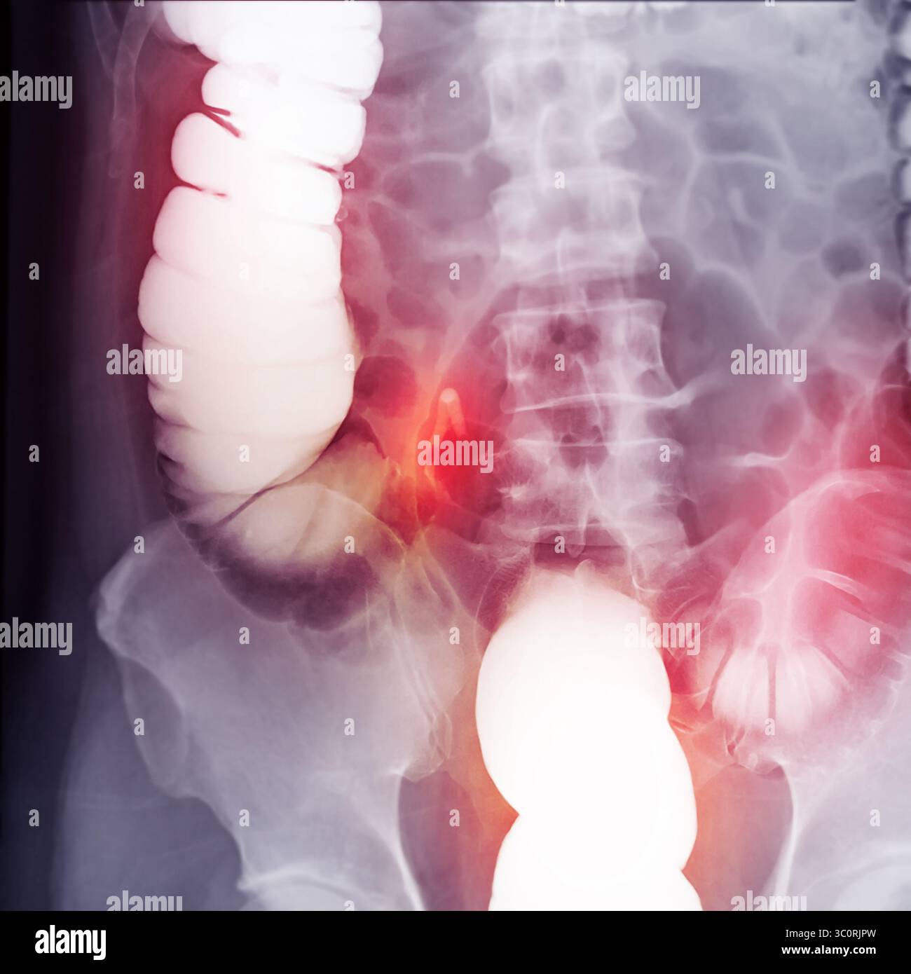 Immagine diagnostica dell'enema del bario che mostra la presenza di diverticolosi nel colon trasversale e ascendente, dimostrando la tipica f diverticolare Foto Stock