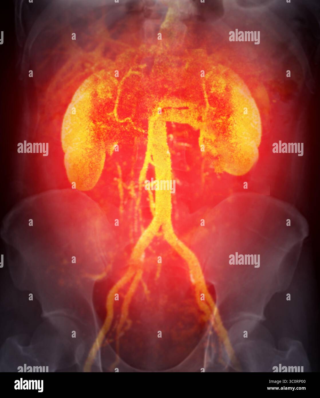 Una scansione radiografica che mostra i reni e le arterie renali, con una visione chiara della via arteriosa e della funzionalità renale sana. Foto Stock