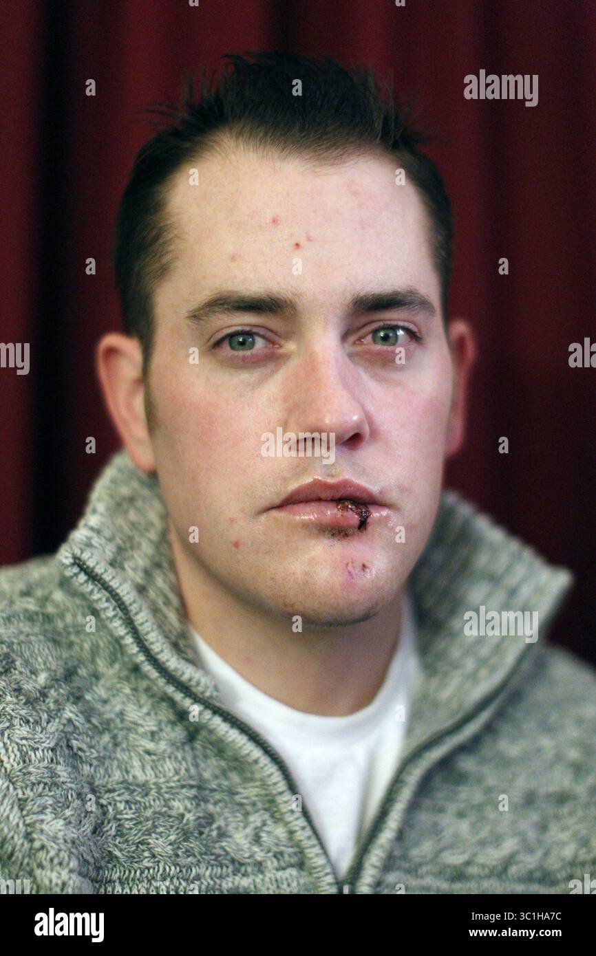 5 marzo 2012 - Stati Uniti - nella sua casa di Savage, Jon Stacke, un veterano iracheno è stato vittima dell'incidente di lancio del morso che gli ha rotto la mascella e gli ha rotto i denti. , Jon Stacke (immagine di credito: Richard Tsong-Taatarii/Minneapolis Star Tribune/TNS via ZUMA Wire) Foto Stock