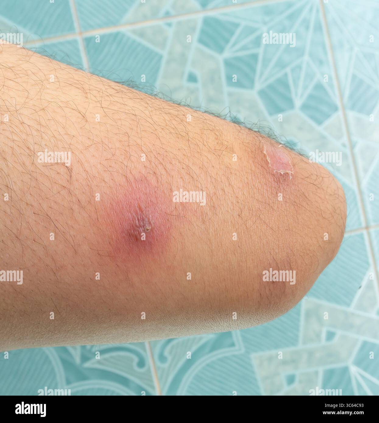 ascesso o malattia della pelle aumenta sulla coscia umana con cicatrici. Foto Stock