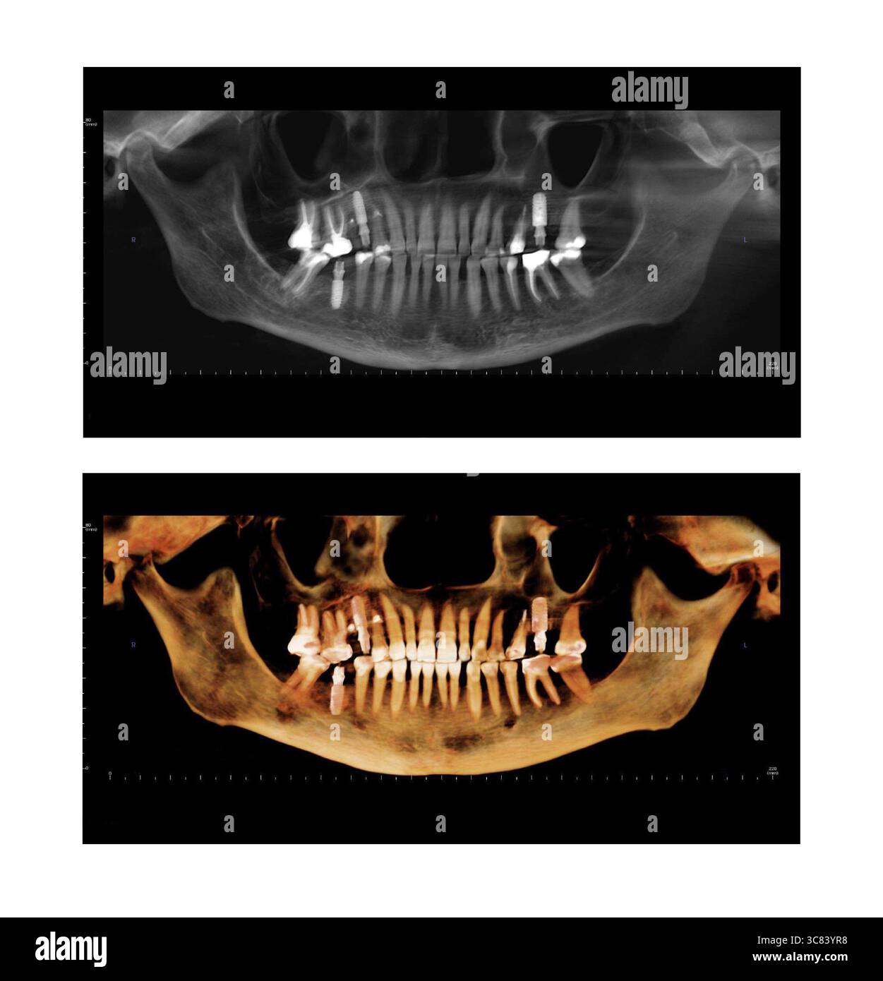 Tomografia computerizzata di pazienti di sesso femminile adulta con trattamenti dentali per la radice e l'impianto. Radiografia dentale di un paziente adulto che mostra denti, mascelle e un dentale Foto Stock