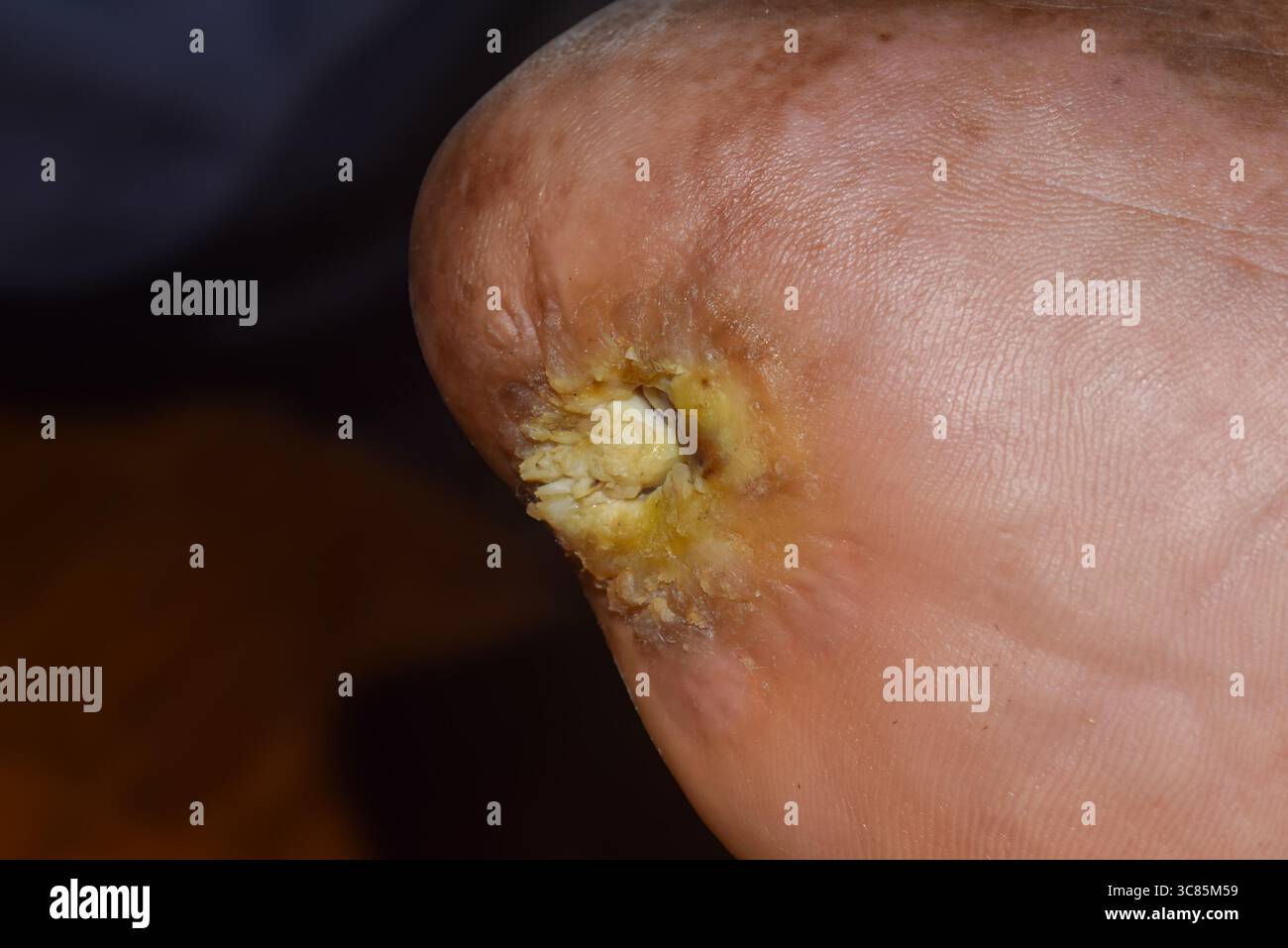 Sul tallone di un piede è visibile un'ulcera grande e profonda con tessuto necrotico e scarico giallastro. Foto Stock