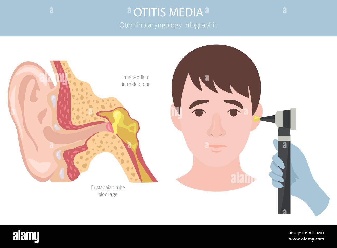 Otite media. Infezione nell'orecchio medio. Infografica sui disturbi otologici. Illustrazione vettoriale Illustrazione Vettoriale
