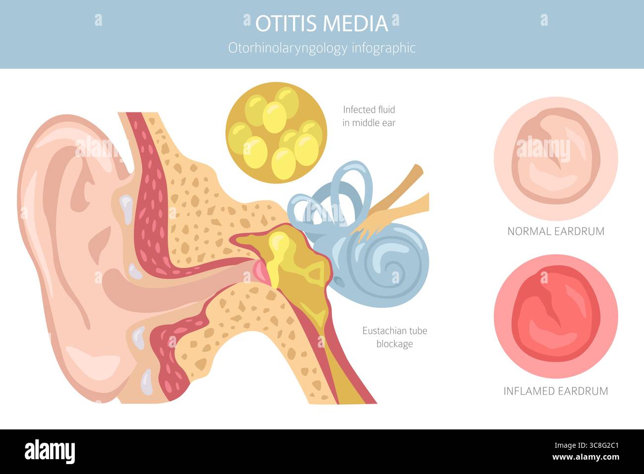 Otite media. Infezione nell'orecchio medio. Infografica sui disturbi otologici. Illustrazione vettoriale Illustrazione Vettoriale