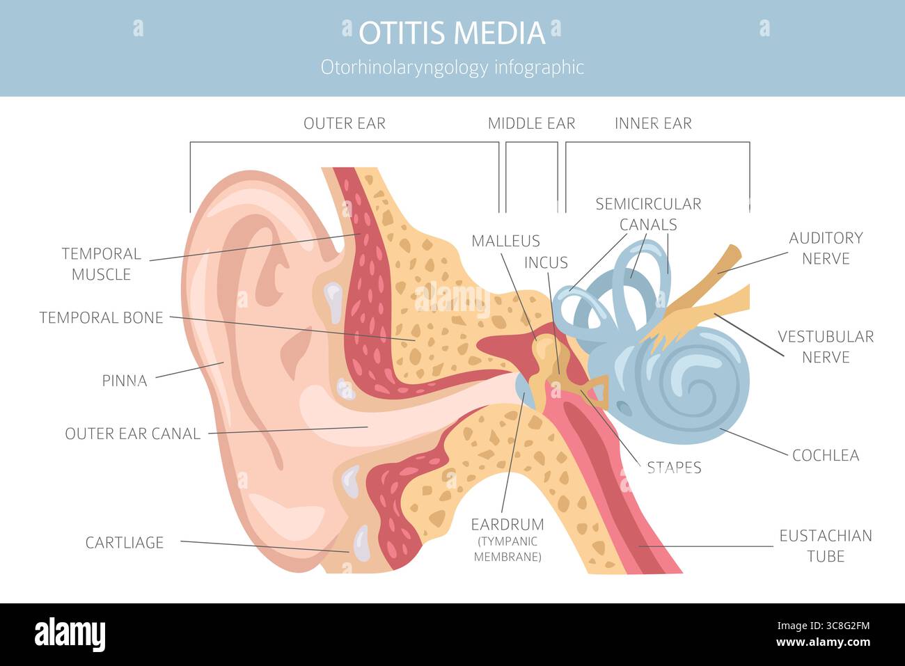 Otite media. Infezione nell'orecchio medio. Infografica sui disturbi otologici. Illustrazione vettoriale Illustrazione Vettoriale