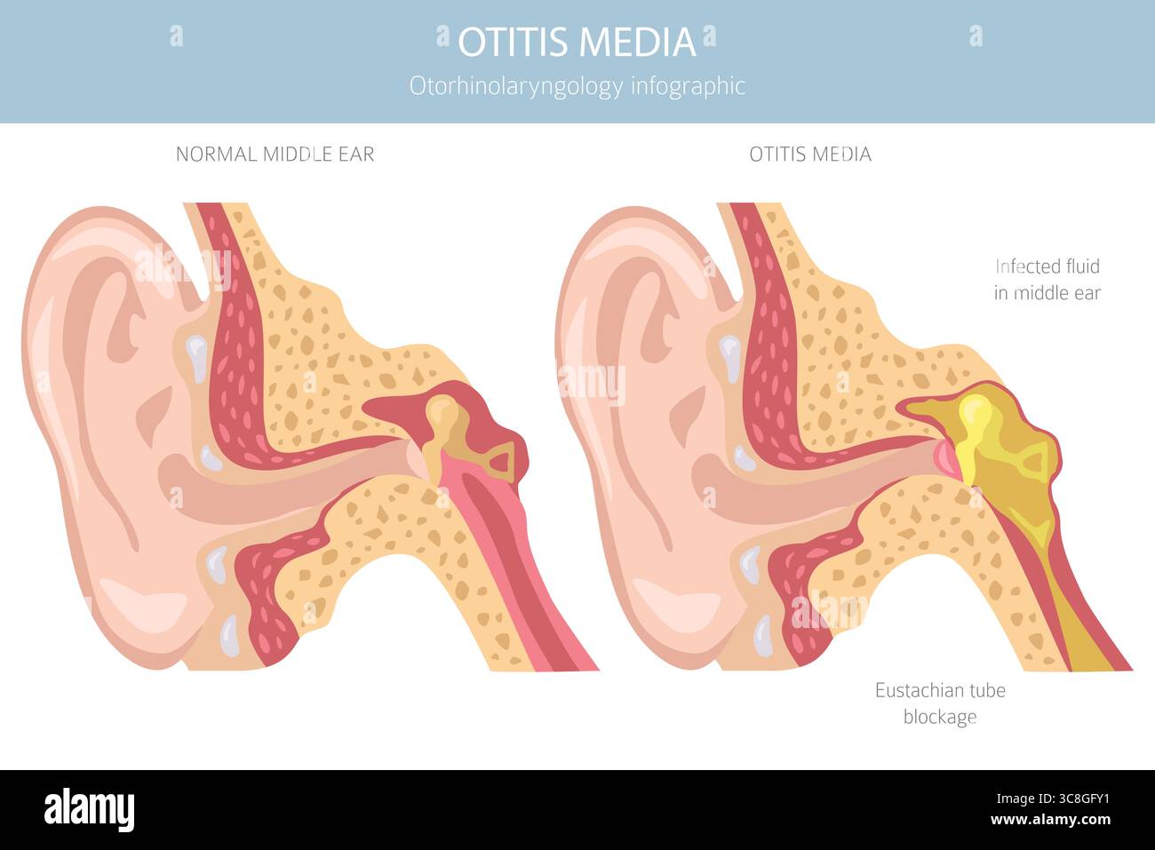 Otite media. Infezione nell'orecchio medio. Infografica sui disturbi otologici. Illustrazione vettoriale Illustrazione Vettoriale