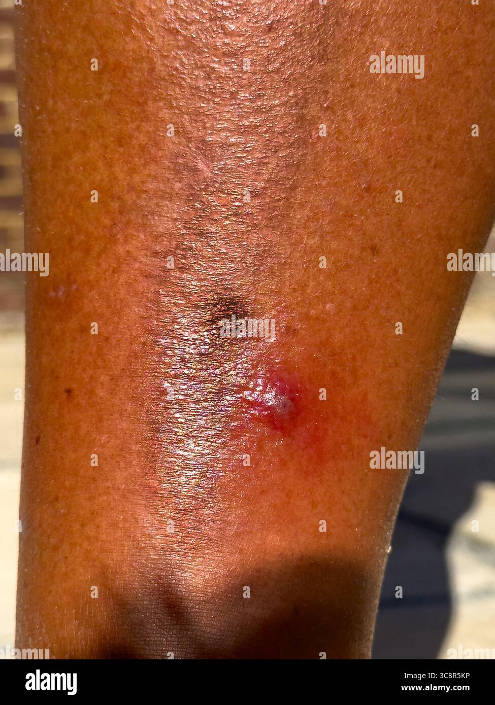 Una gamba infetta dopo un morso di mosca del cavallo Foto Stock