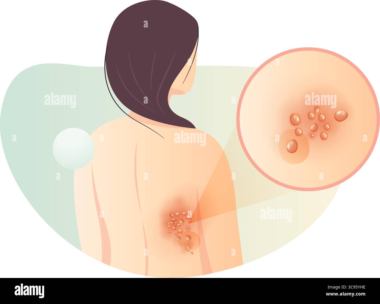 Un lato eruzioni sul retro - Herpes zoster - Shingles - Stock Illustration as EPS 10 file Illustrazione Vettoriale