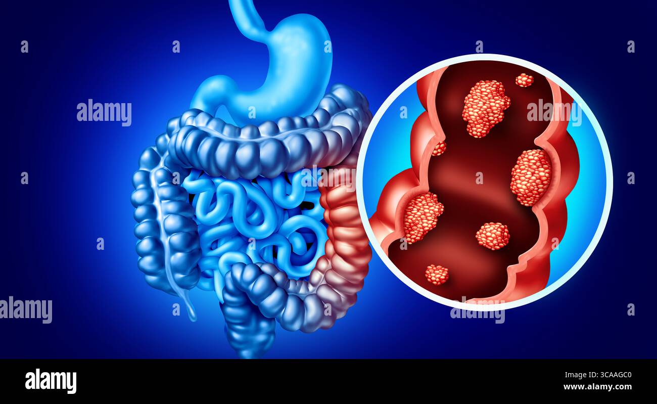Concetto di cancro colorettale come una malattia del colon illustrazione medica di un intestino crasso con una malattia maligna della crescita tumorale del sistema digerente. Foto Stock