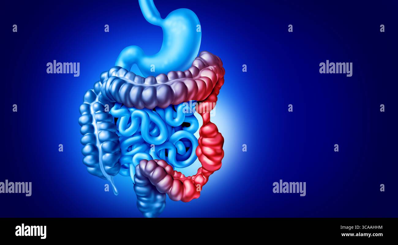 Sintomi IBS illustrazione medica e anatomica malattia digestiva e concetto di disturbo cronico come sindrome dell'intestino irritabile doloroso e dolore intestinale Foto Stock