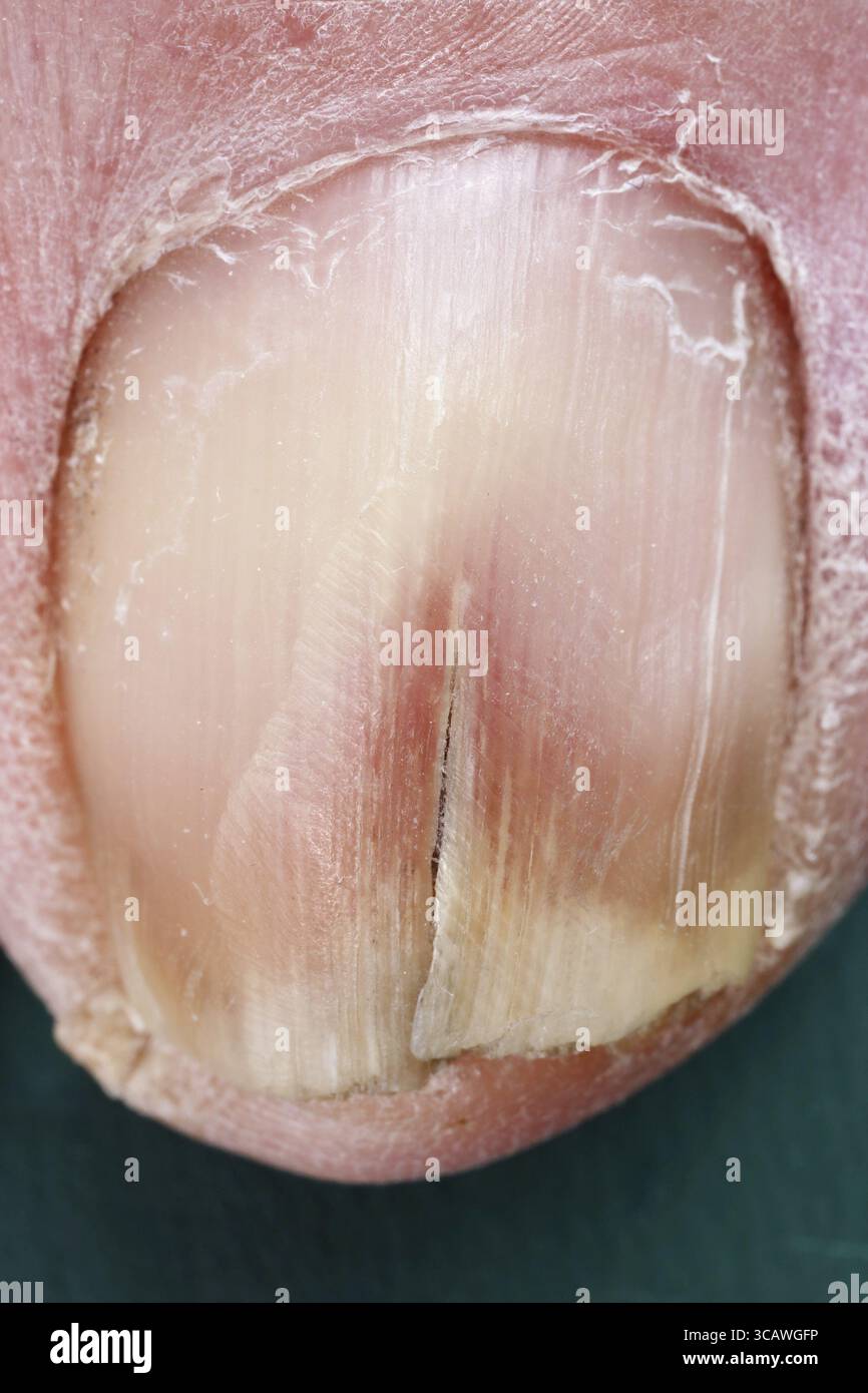 Il vecchio uomo è il suo taglio di unghie sul piede con un file. Questo aiuta a evitare la crescita ossea in carne. Studio real shot macro. Arte soft focus Foto Stock