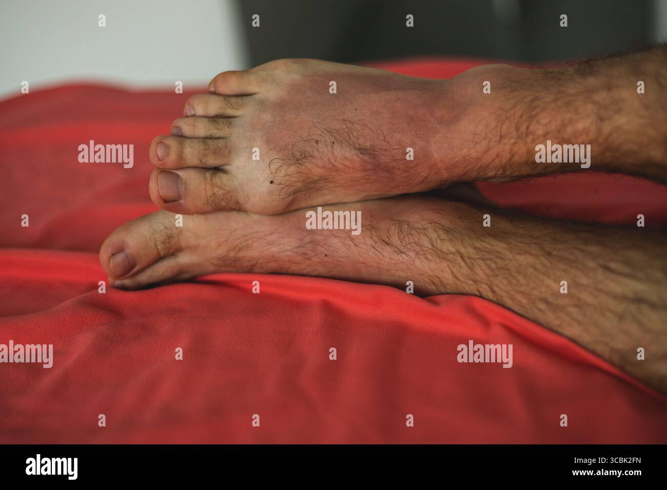 Gambe maschili bruciate al sole. pelle rossa dei piedi Foto Stock